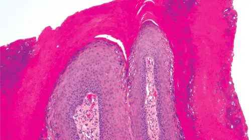 PCR Wound Specimen