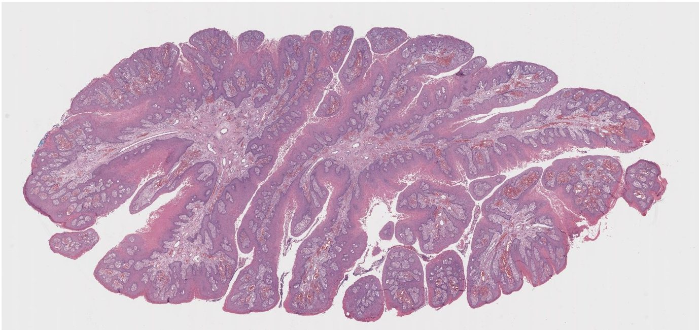 Dermatopathology Case Review: Verruciform Xanthom