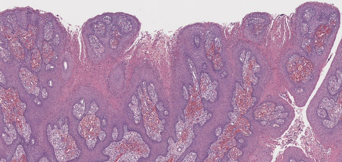 Sagis Dermatopathology Case Review: Verruciform Xanthom