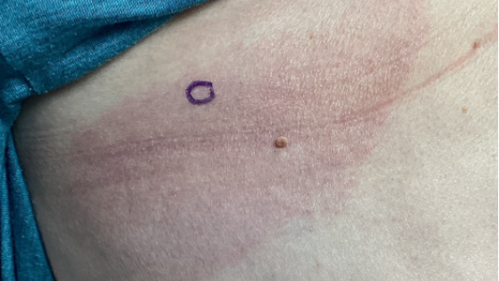 Patient: 69-year-old female Lesion Location: Right rib cage and left hip Clinical Presentation: One-year history of asymptomatic, bilaterally distributed erythematous patches on the trunk A biopsy of the patch lesion was performed to establish a definitive diagnosis.