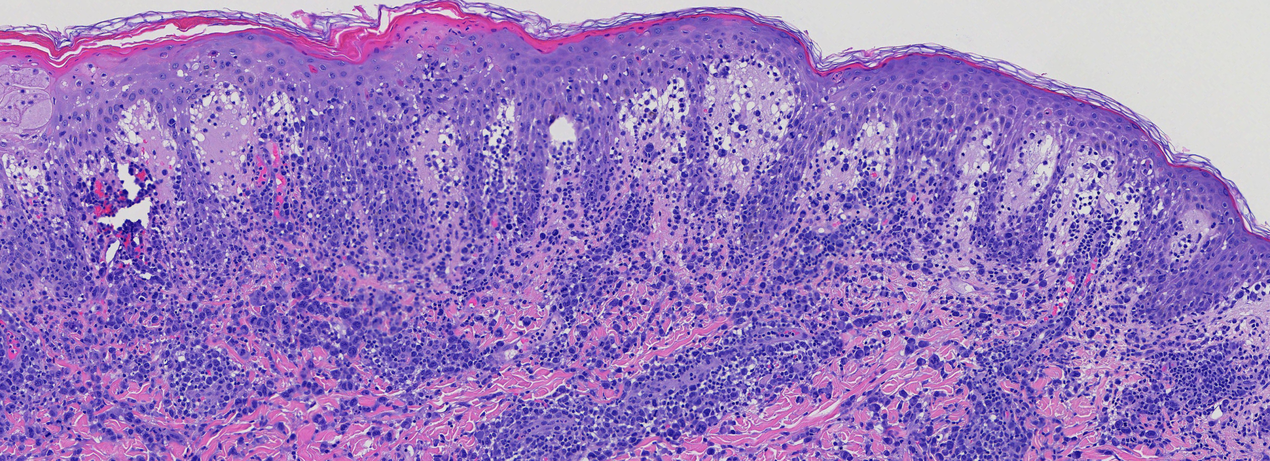 LYMPHOMATOID PAPULOSIS 