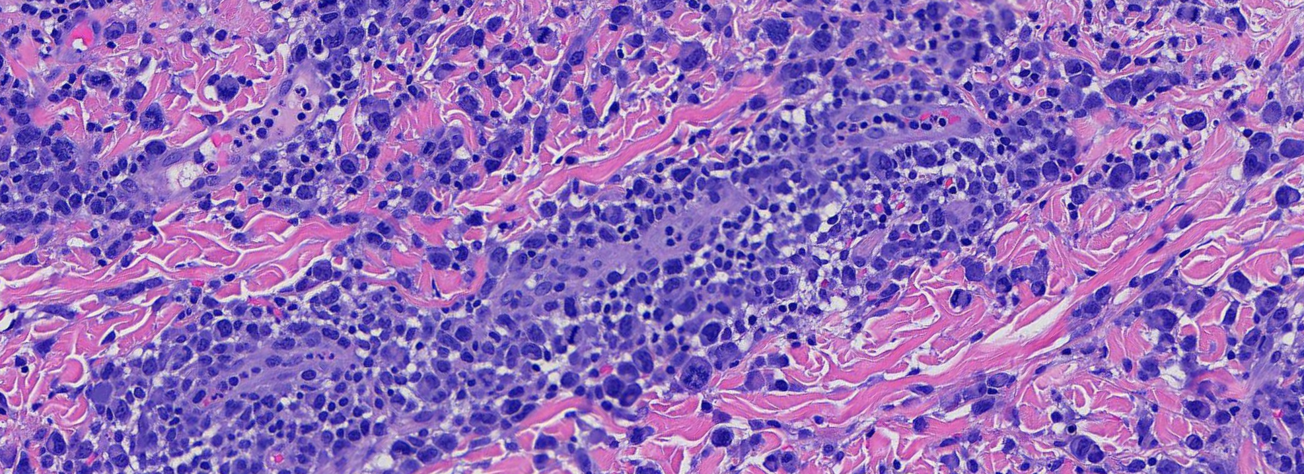 LYMPHOMATOID PAPULOSIS 