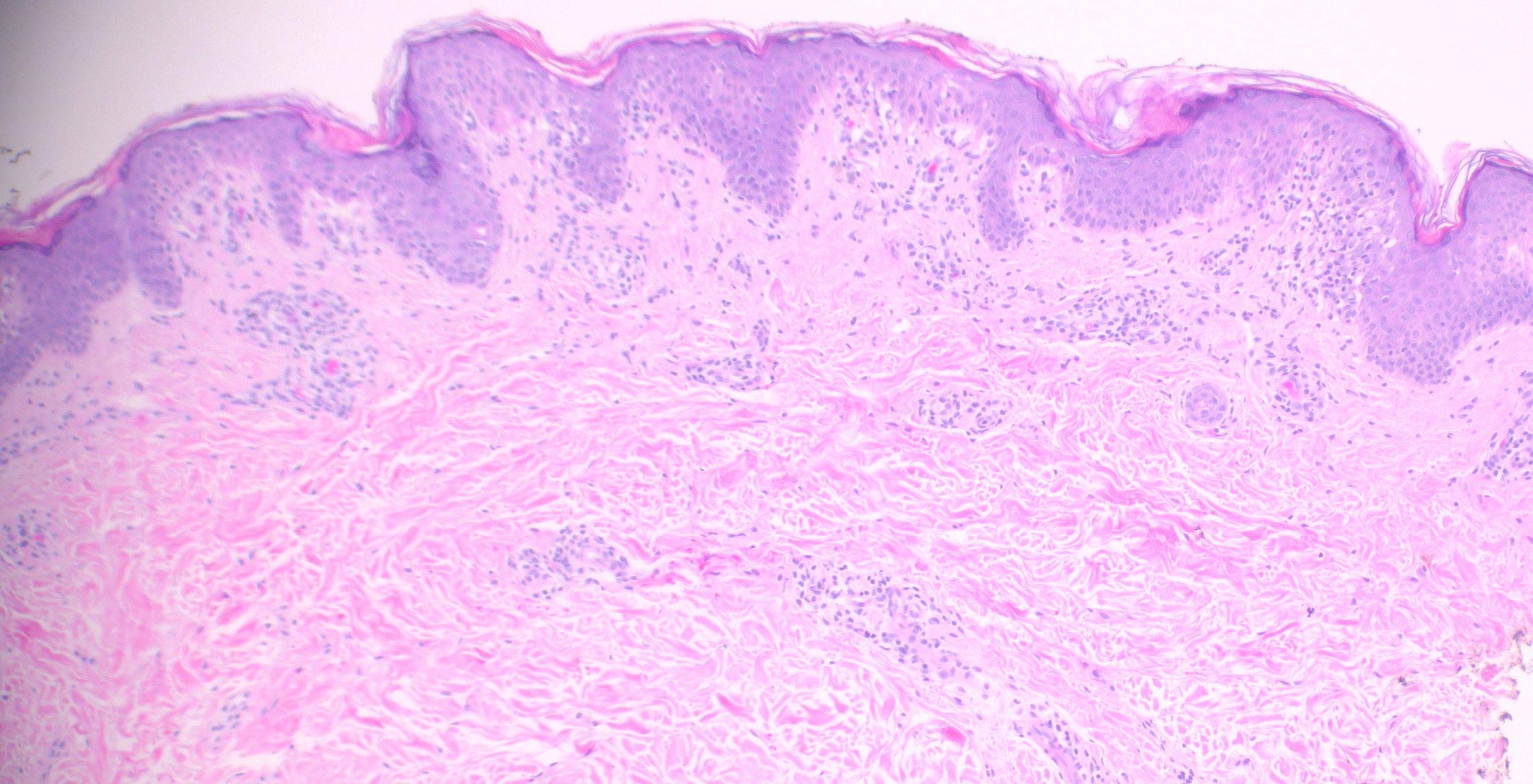 PLEVA (Low-power histologic view of diffuse rash biopsy)