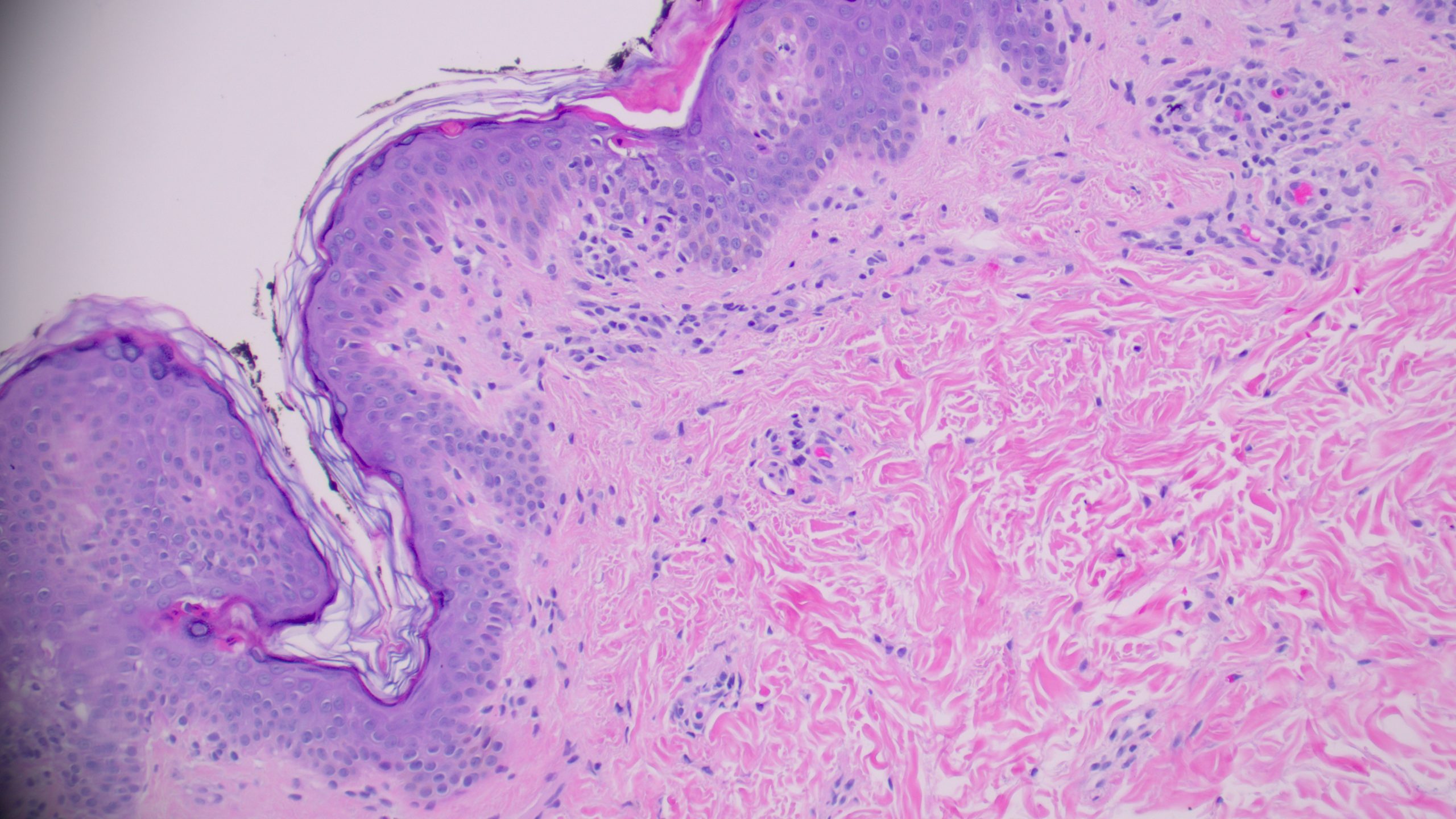 PLEVA (Medium power showing wedge-shaped perivascular lymphocytic infiltrate)
