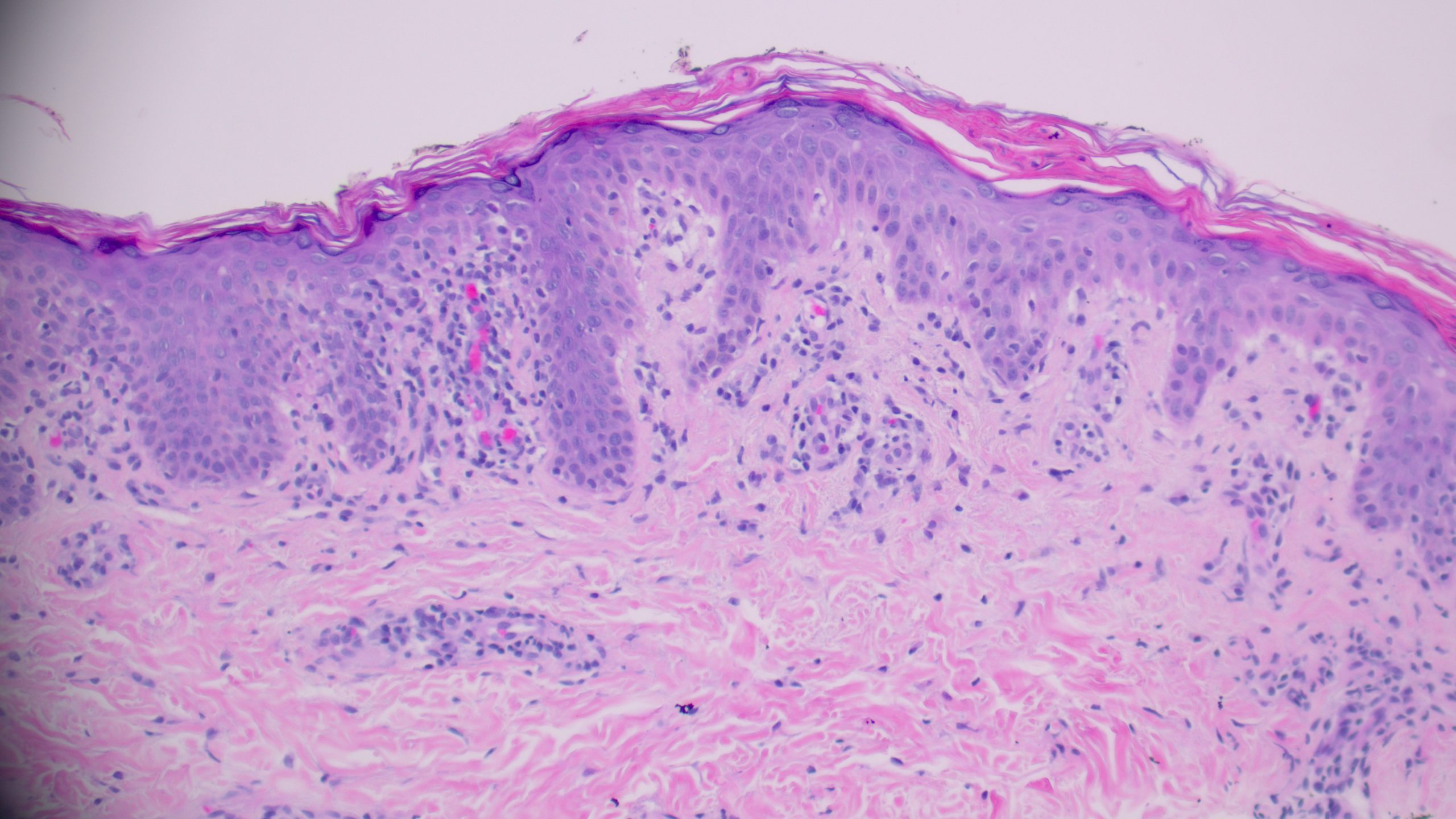 PLEVA (High power showing necrotic keratinocytes and erythrocyte extravasation into the epidermis)