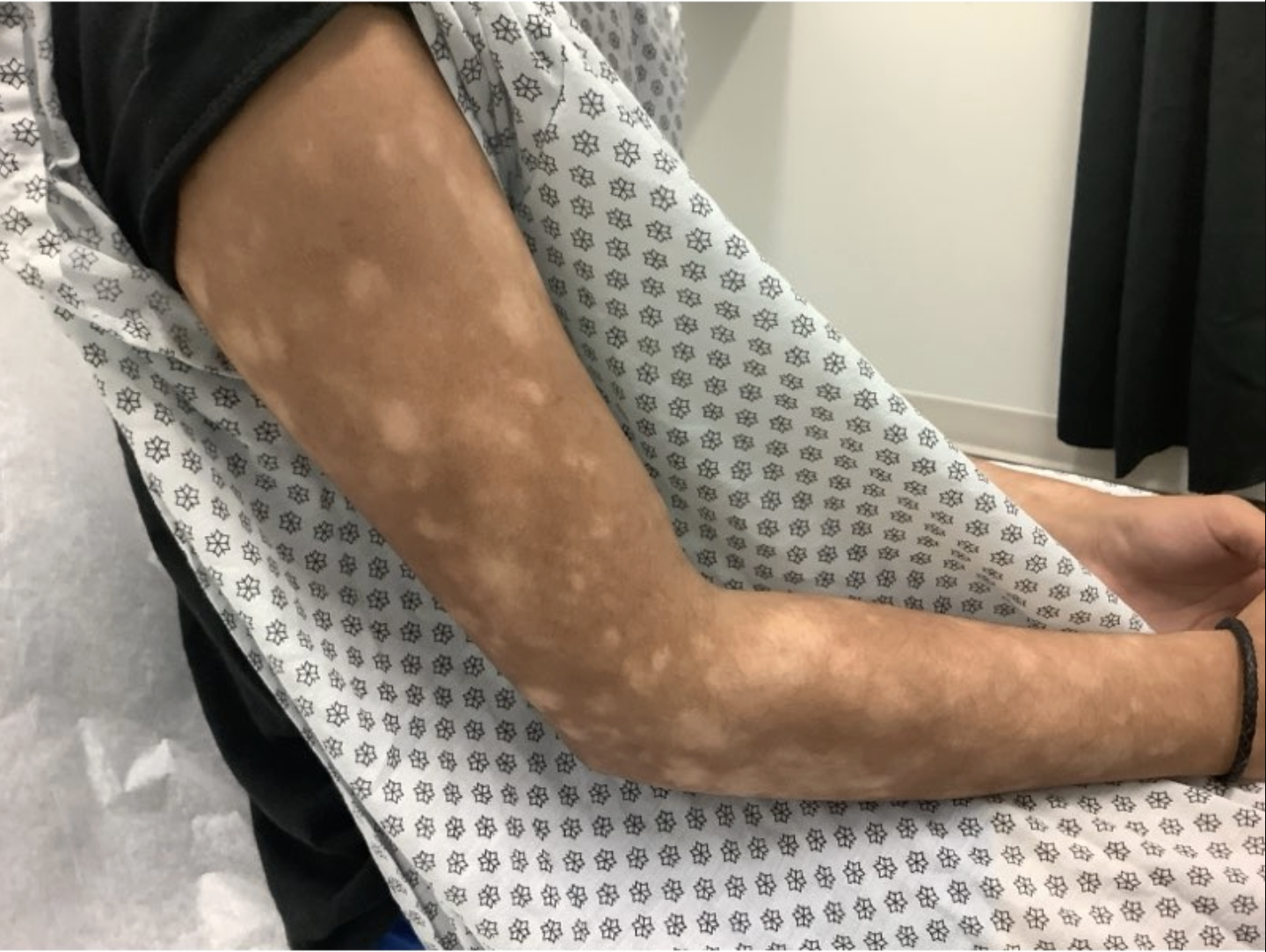 CD8+ Hypopigmented Mycosis Fungoides clinical image