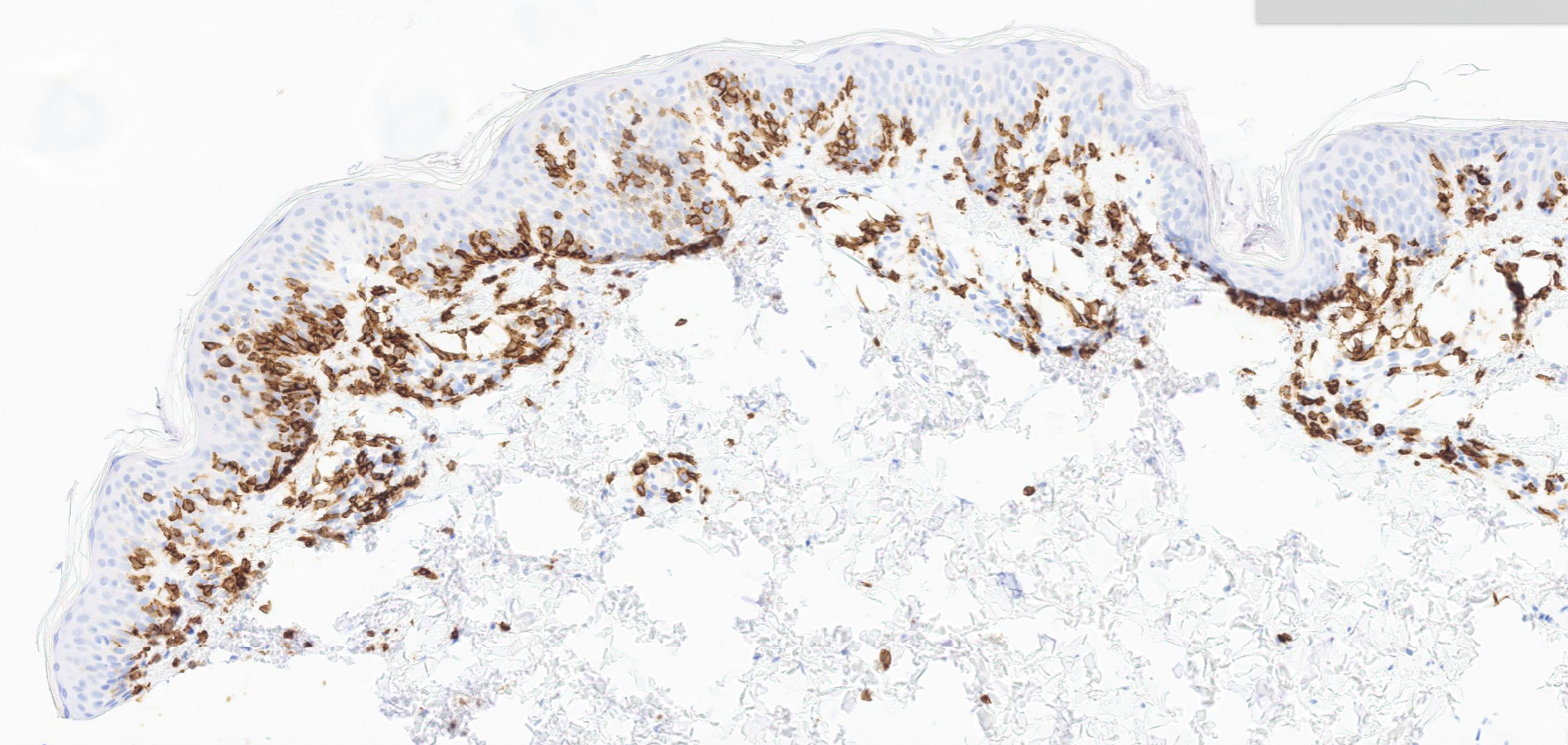 CD8+ Hypopigmented Mycosis Fungoides