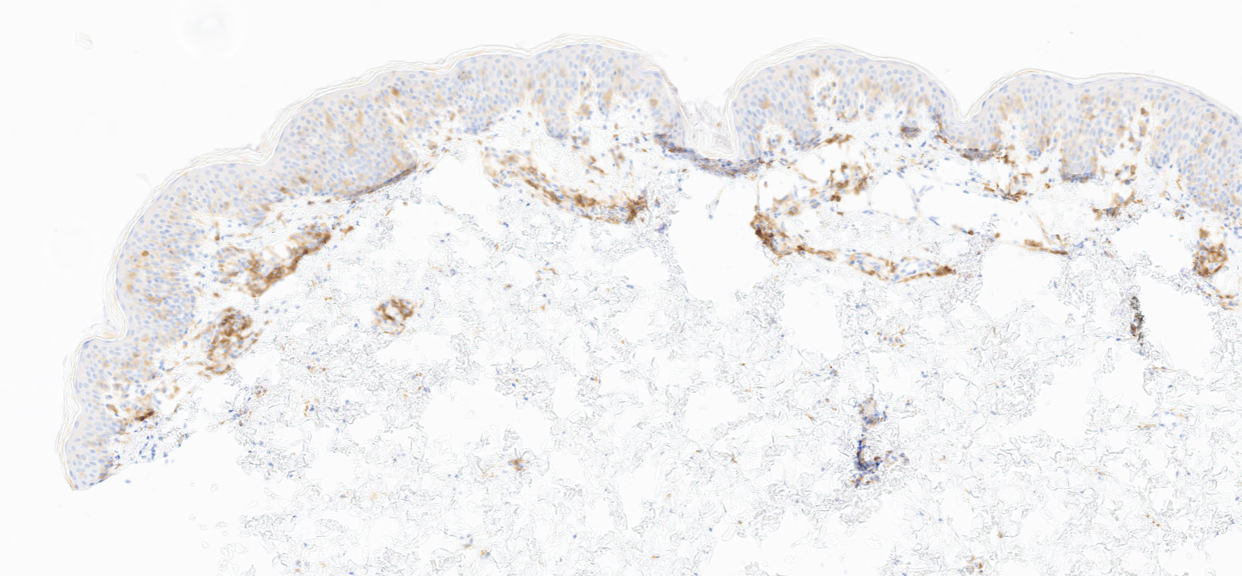 CD8+ Hypopigmented Mycosis Fungoides