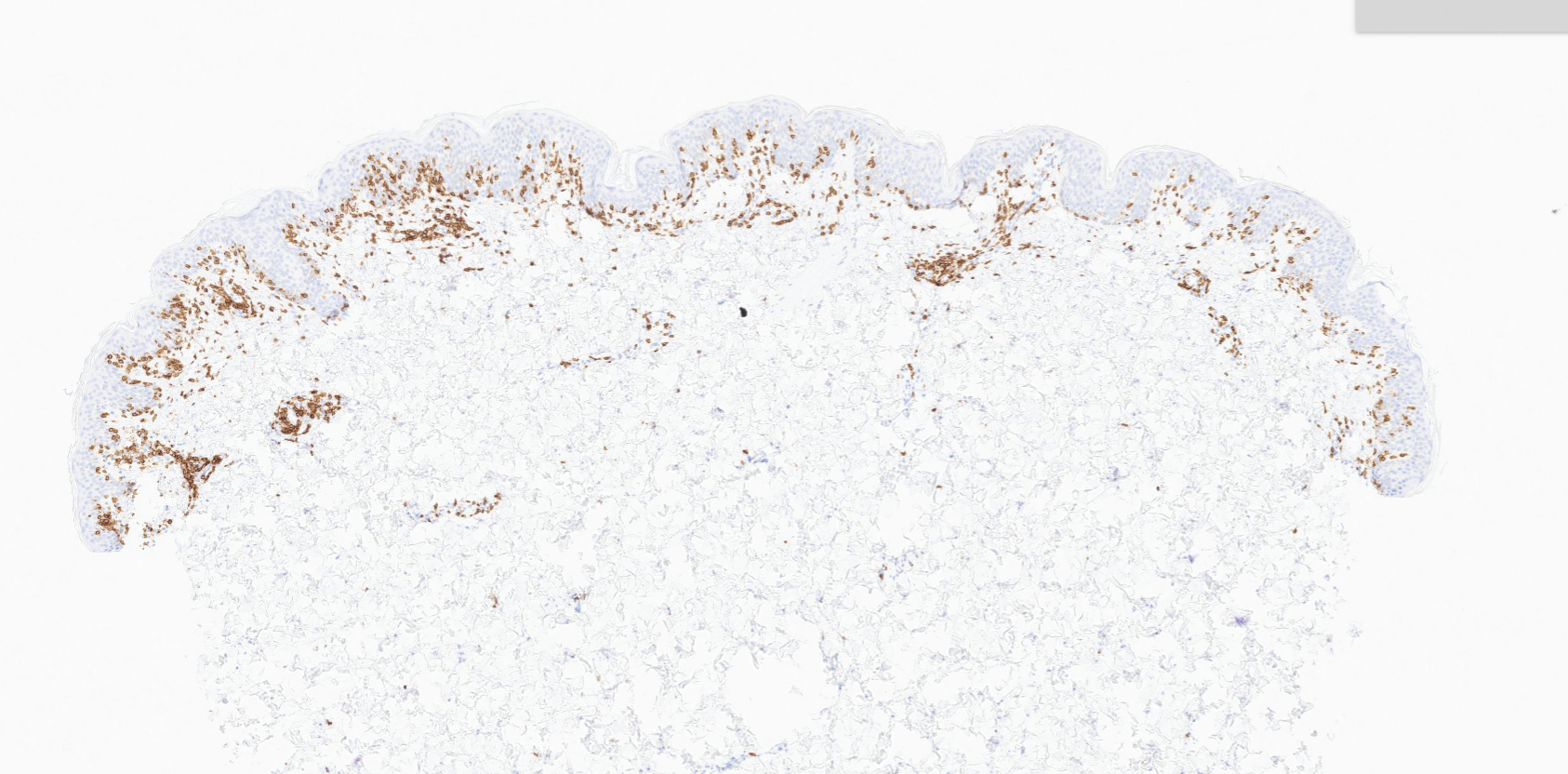 CD8+ Hypopigmented Mycosis Fungoides