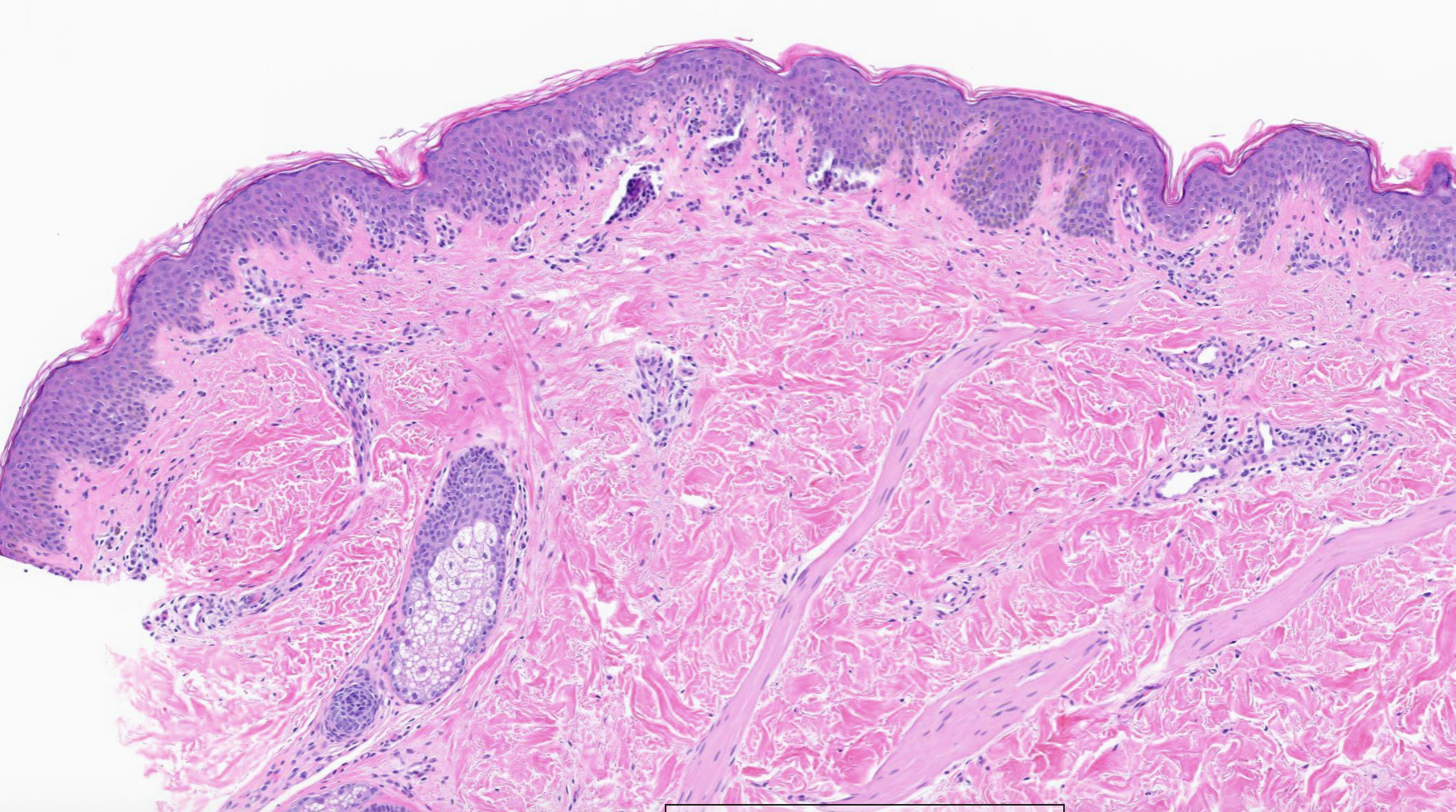 CD8+ Hypopigmented Mycosis Fungoides